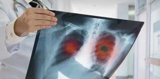 Doctor holding lung X-ray with highlighted areas.